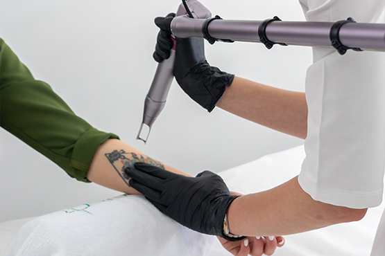 How Pico Laser Tattoo Removal Clears Ink Faster With Less Pain
